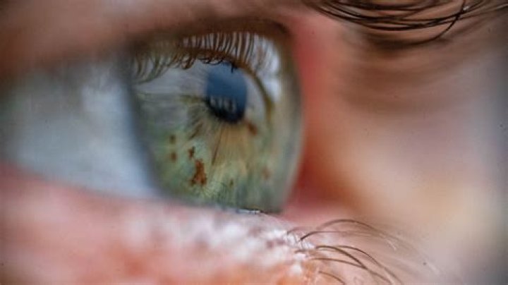 Understanding Trace Gallagher's Eye Condition