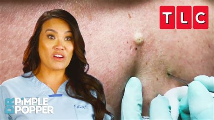 Watch Dr. Pimple Popper extract a huge blackhead hiding behind a woman's ear